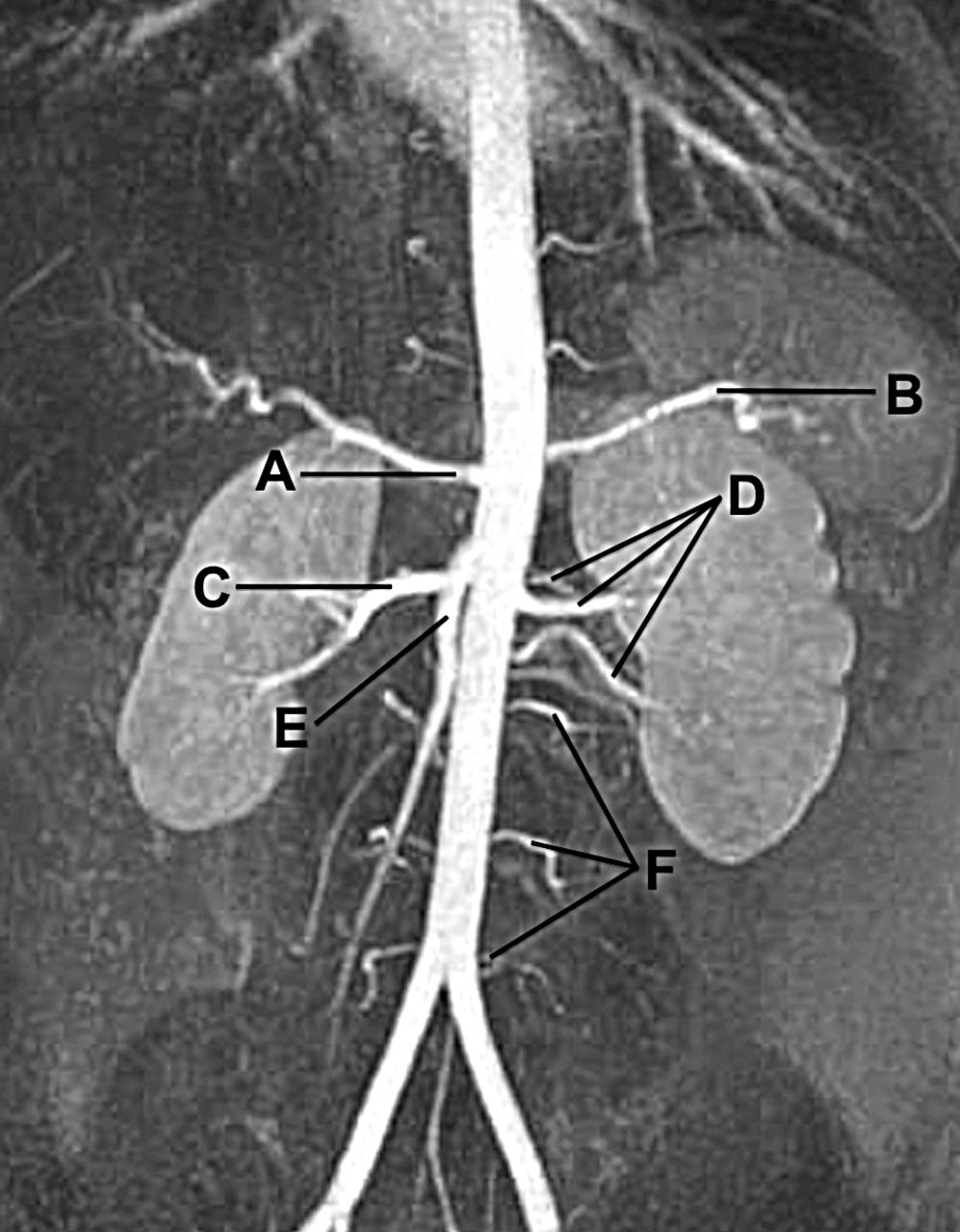 Lab test image of MRI Renal Angiography