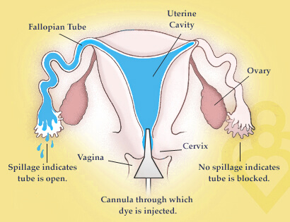 Lab test image of HSG (Hysterosalpingogram)