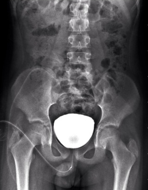 Lab test image of MCU (Micturating Cysto-Urethrogram)