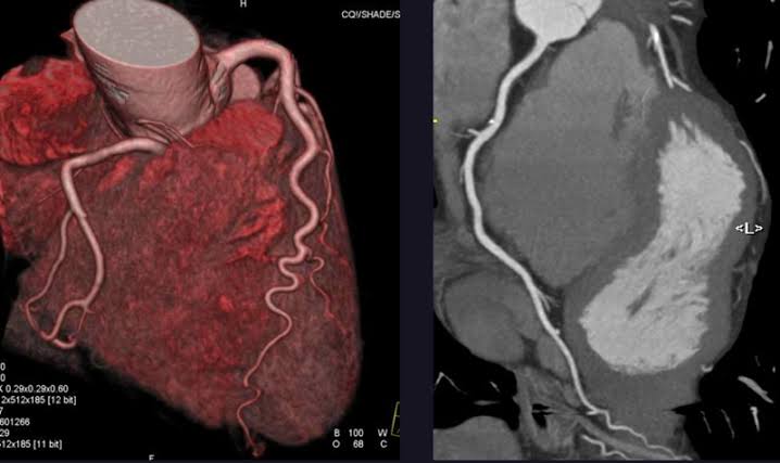 Lab test image of CT Cardiac Angiography