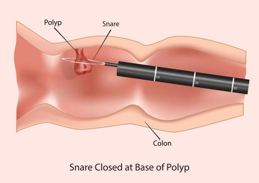 Lab test image of Colonoscopy