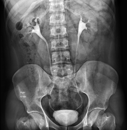 Lab test image of IVP (intravenous pyelogram)