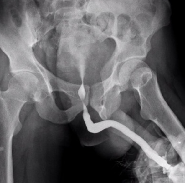 Lab test image of RGU (Retrograde Urethrogram) X-RAY