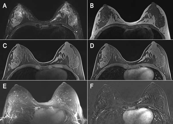 Lab test image of MRI Mammography