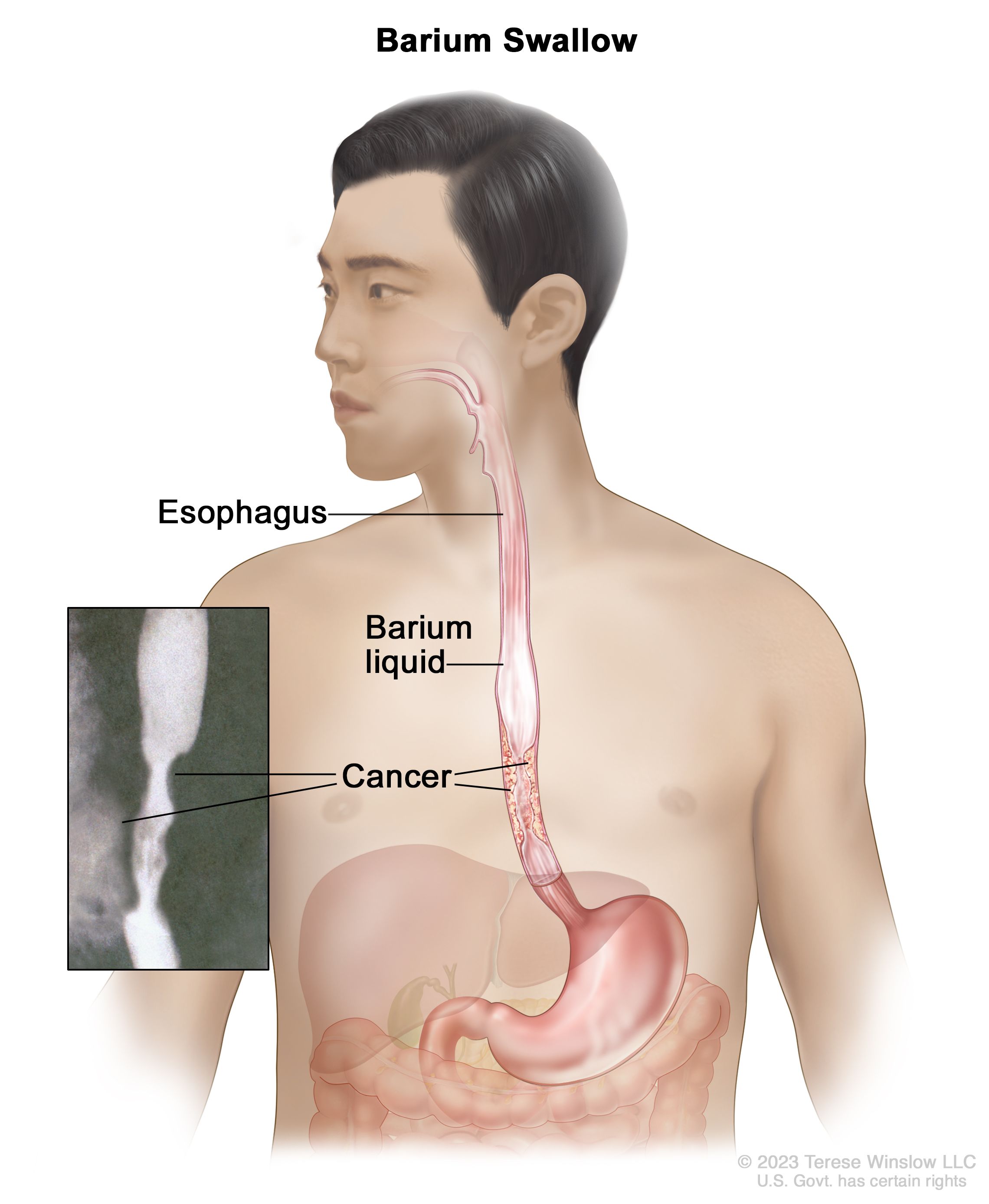 Lab test image of Barium Swallow
