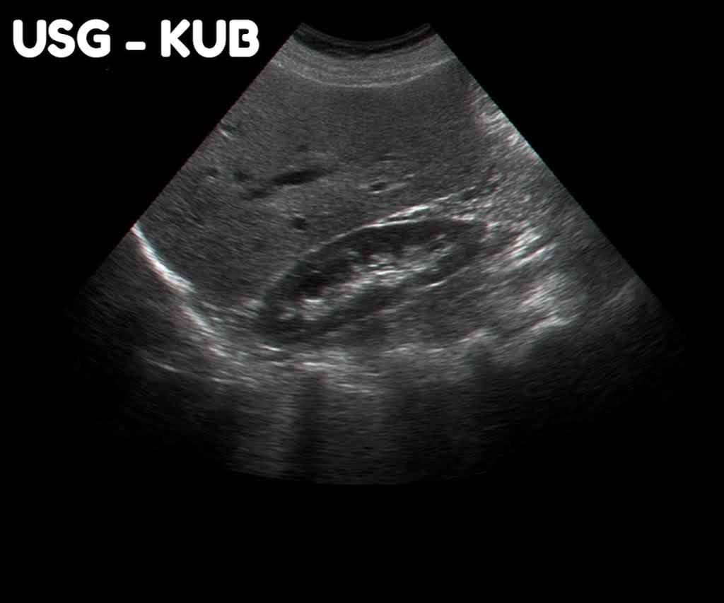 ULTRASOUND KUB